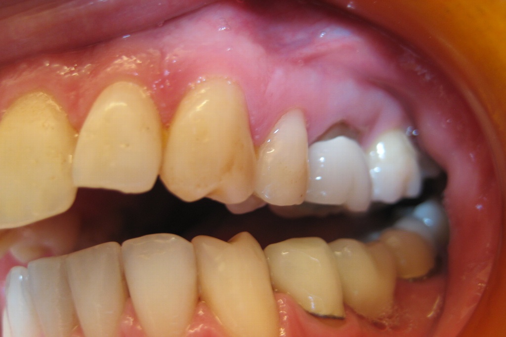 Dientes dañados podrían ser factor de riesgo para cáncer de boca ...