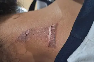 Bullying: Queman a niño en secundaria de Veracruz; madre teme por la vida de su hijo