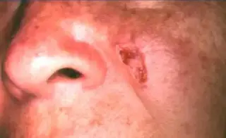 Imagen Cáncer de piel: conoce un poco de esta enfermedad y cuáles son sus síntomas 